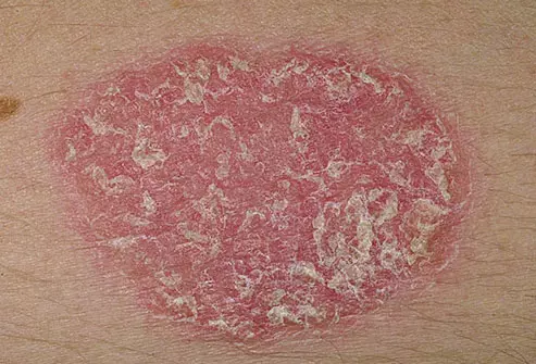 Dermnet Rf Photo Of Psoriasis Plaque