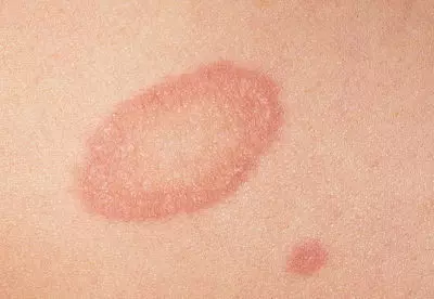 Pyatnonakozheskrasnimobodkom Afa81abc