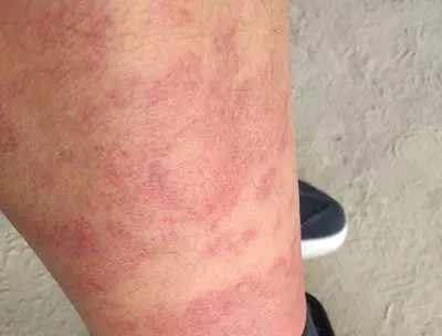 Vysyp Na Shkiri Borshchivnyk