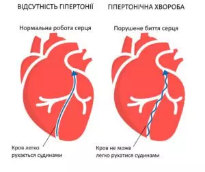Lechenie Gipertonicheskoy Bolezni V Zaporozhe Ukr 300x251 1