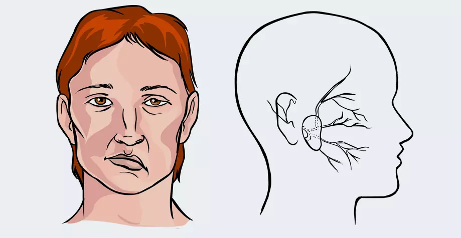 Mikroinsult Simptomy Lechenie 4 7