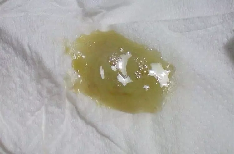 Zelenye Vydeleniya Pri Beremennosti Prichiny I Lechenie98